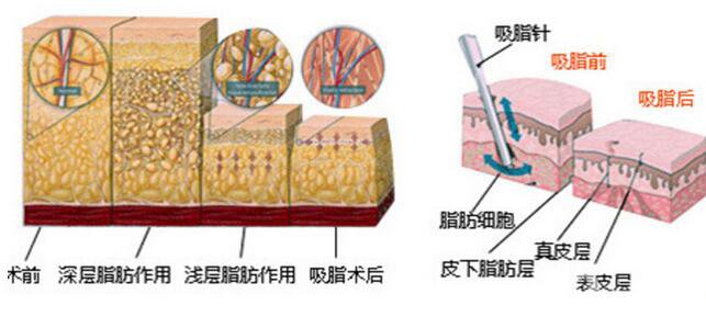 抽脂多少钱 做抽脂手术贵不贵？