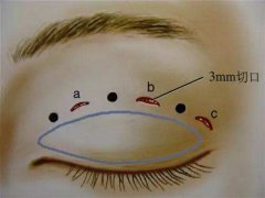 深圳韩式三点双眼皮多少钱