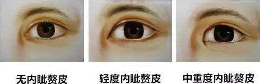 上海眼部整形失败修复价格