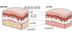 吸脂价格多少？吸脂价格详细分析