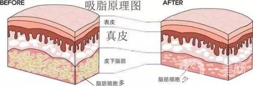 吸脂的价格一般是多少？价格差异大吗？