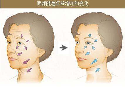 生物除皱的价格是多少 生物除皱收费明细