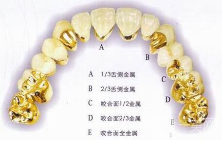 黄金烤瓷牙多少钱一颗？黄金烤瓷牙价格详解