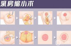 巨乳缩小疤痕严重怎么办 巨乳缩小后祛疤方法