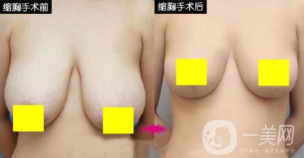 乳房太大如何缩小 乳房缩小提升手术图片