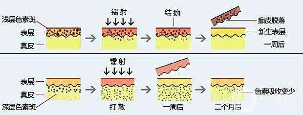 老年斑怎么调节 激光去老年斑怎么样