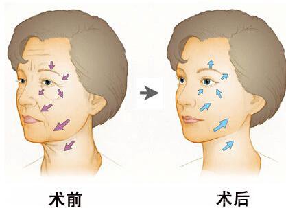 伊维兰除皱要多少钱 价格是多少