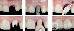 种植牙能用多长时间 种植牙能保持多久