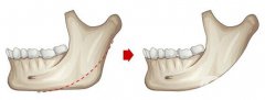 磨骨手术做完有些什么后遗症？