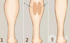 注射瘦脸注射瘦腿的价格 注射瘦脸注射瘦腿费用介绍