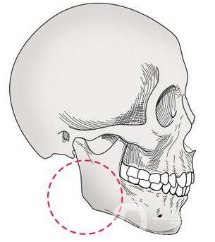 下颌角截骨手术头套戴多久 恢复期要多久？