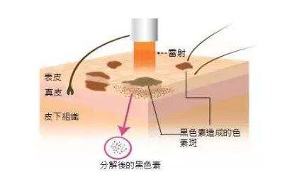 像素激光祛斑,价格