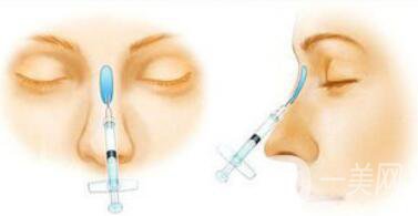 武汉注射隆鼻失败修复价格多少