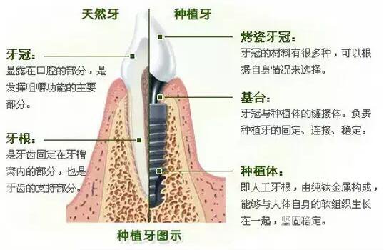 昆山种植牙价格要多少钱