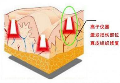 上海做一次像素激光去疤痕手术调节多少钱