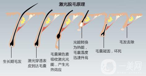 北京激光脱毛费用介绍 价格详情