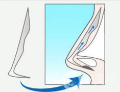 硅胶隆鼻整形之后为什么会感染