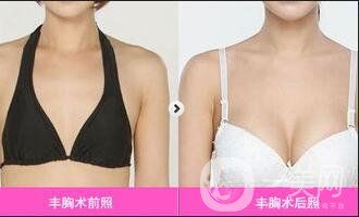 乳房再造整形手术价格