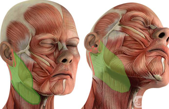 颈部松弛怎么办 微创颈年轻化手术-聚四氟乙烯(PTFE)除皱术