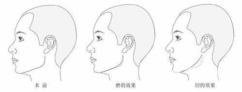 下颌角磨骨多久能喝酒 下颌角磨骨恢复时间