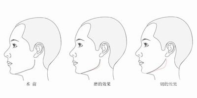 削骨手术危险吗 削骨手术*果怎么样