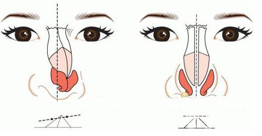 歪鼻矫正手术多少钱 歪鼻矫正*果怎么样