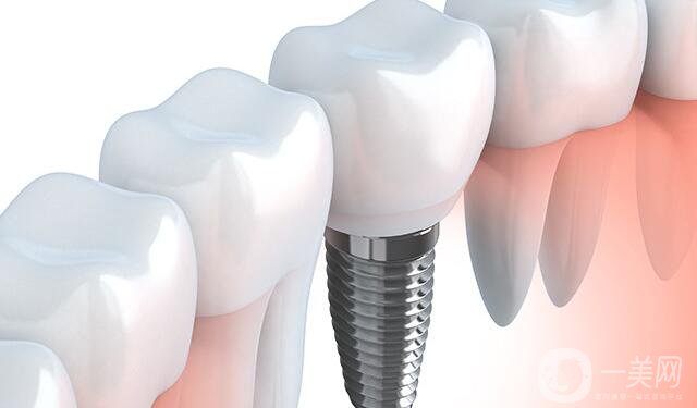 深圳种植牙价格,深圳种植牙多少钱