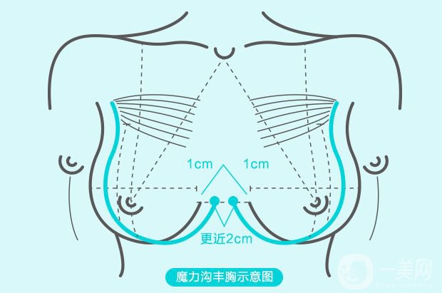 沃斯堡丰胸术怎么样 隆胸的风险有多大？