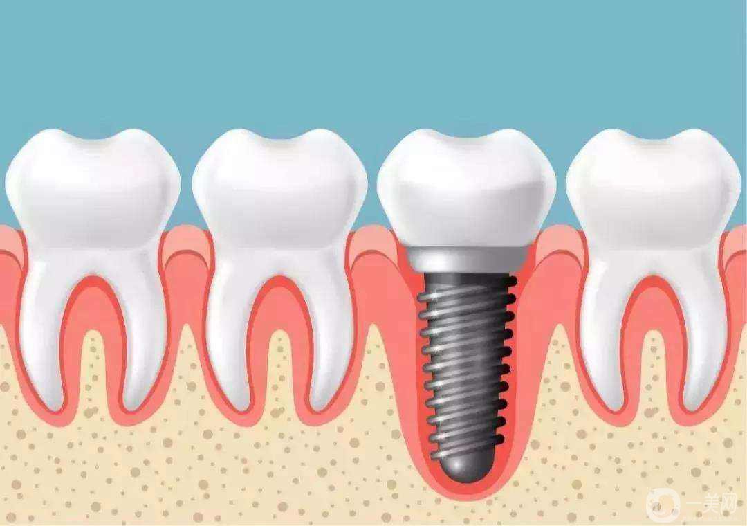种植牙的过程 种植牙齿的种类有哪些？