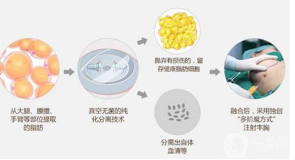 自体脂肪隆胸价格 自体脂肪丰胸后的危害