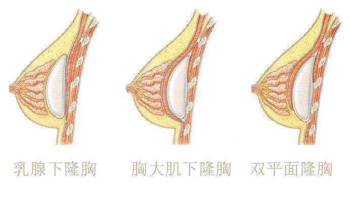 双平面隆胸的缺点是什么 *果自然吗