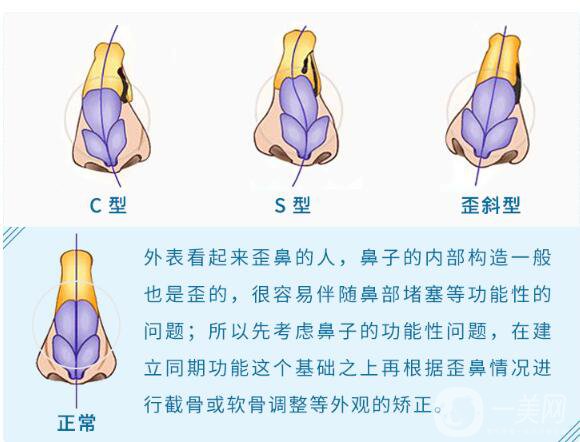 歪鼻矫正手术是怎样的 手术方法有哪些？