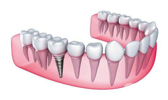 种牙的价格多少 影响种牙价格的原因是什么
