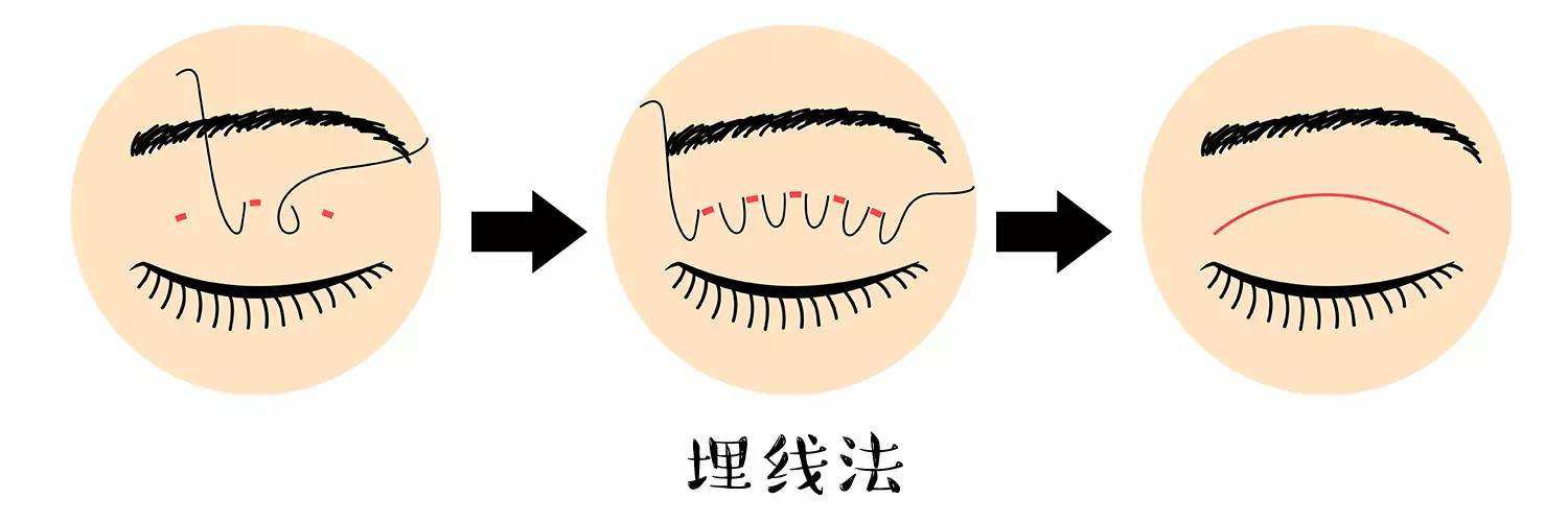 不开刀的双眼皮手术有哪些？