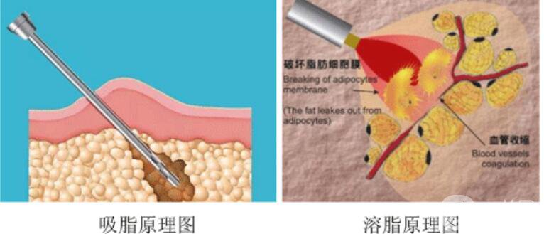 吸脂,溶脂