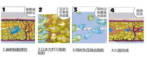 负压吸脂*果和水动力一样吗?哪个更好?