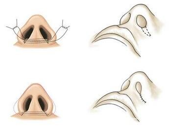 内切鼻翼缩小多久才能恢复？是否会留下疤痕？