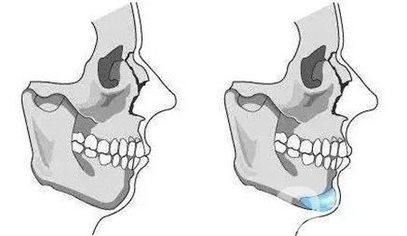 隆下巴假体硅胶好还是膨体好？