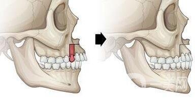 上颌后缩怎么矫正？手术有风险吗？