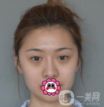 延吉金光善整形美容医院价格表收费明细_双眼皮手术真人体验分享