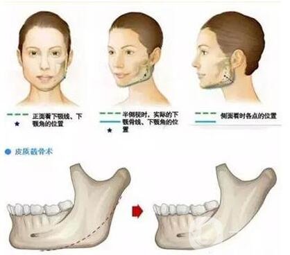 整形科普|下颌角整形手术的并发症和适合人群