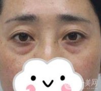 第九人民医院美容科价格表，去眼袋手术恢复情况一览