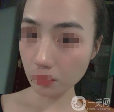 南京省中医院整形美容科祛黄褐斑多少钱？价格表及案例详情一览