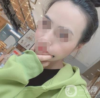 南京省中医院整形美容科祛黄褐斑多少钱？价格表及案例详情一览