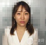 广州高尚医学美容中心隆鼻价格表和案例