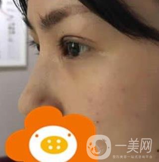 成都*做双眼皮前后*果图，附整形美容科价格收费表一览