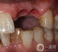 中大光华口腔医院种植牙多少钱?价格表2020年项目明细一览