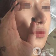 辽宁省人民医院美容科怎么样？附袁继龙隆鼻案例