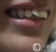 北京医院整牙多少钱？牙齿矫正价格一览表