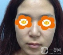 长沙贝美医院做鼻子怎么样?一览价格表费用详情